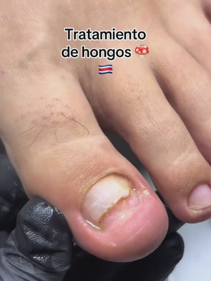 MY FINGER SOLUTION - ELIMINA HONGOS DE PIES Y UÑAS